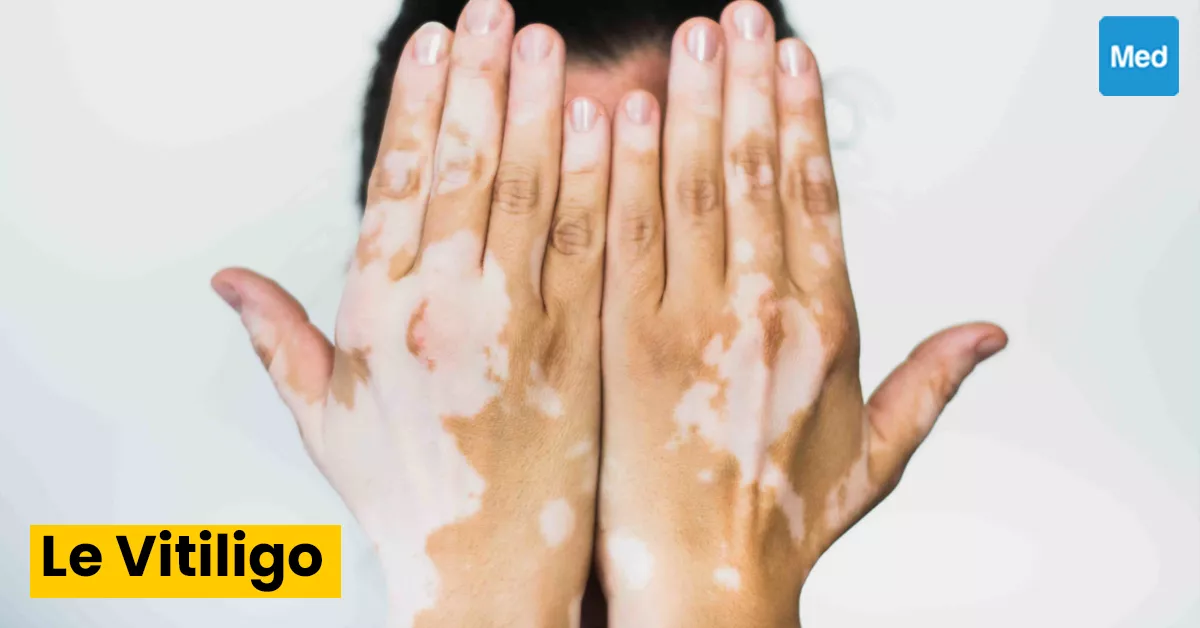 Vitiligo : tout ce que vous devez savoir